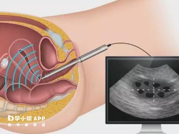 人工授精反复失败要总结经验更换方案