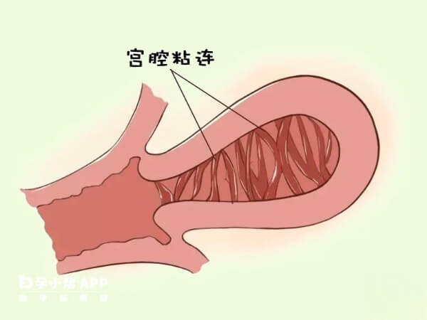 上海宫腔粘连做试管的费用约10万元