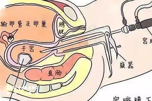 宫腔镜检查主要用于解决宫腔疾病