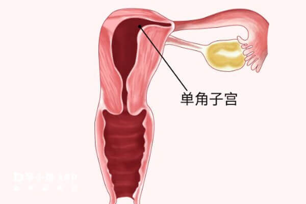 单角子宫做试管婴儿助孕难度较大