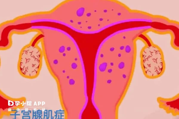 腺肌症做试管婴儿要遵守相关事项