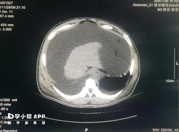 取卵后腹水会有一定症状表现