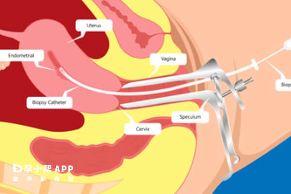 宫腔镜往往是发现异常状况才需要做的