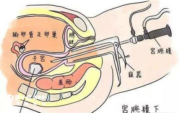 试管前宫腔镜不仅能检查还能治疗