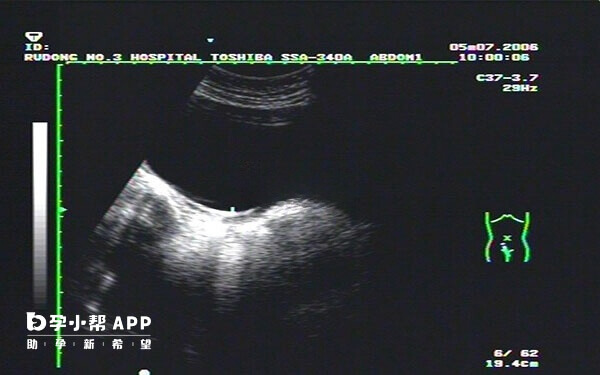 辅助生殖做阴道超声往往选在经期