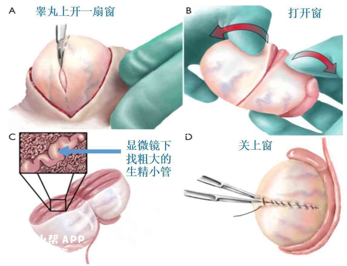 非梗阻性无精子症可显微取精