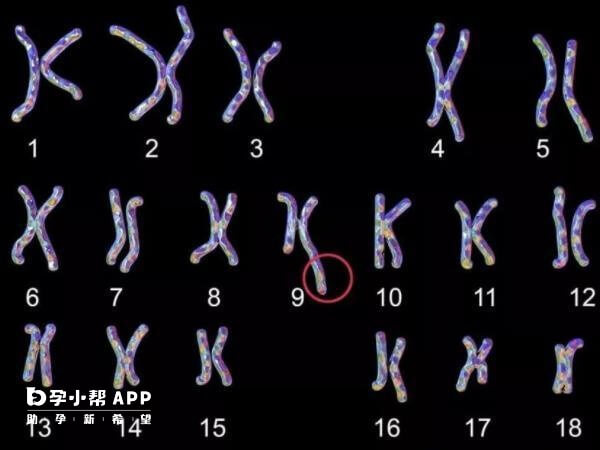 三代试管婴儿能帮助规避克氏综合征