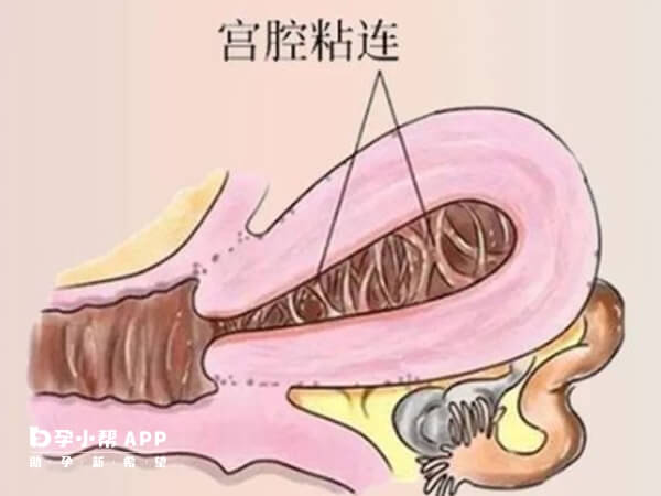 轻度宫腔粘连必须先治疗再移植