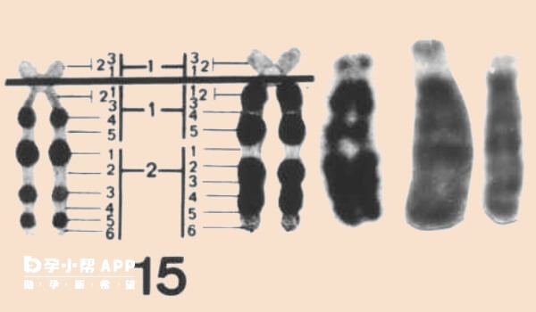 查出15号染色体微缺失大多是不健康的