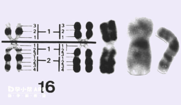 无创提示16号染色体数目偏多不建议留