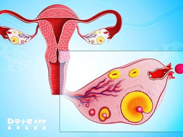 微刺激方案对卵巢伤害小