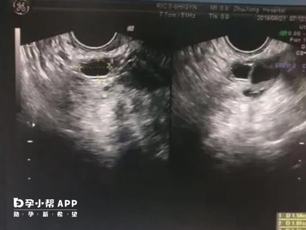 监测排卵能准确把握女性排卵时机