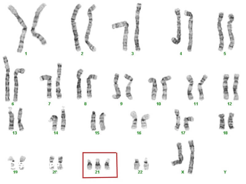 染色体异常需要做遗传咨询