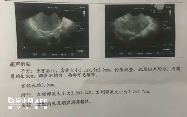 刮宫术会导致内膜变薄