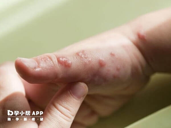 幼儿急疹是一种病毒性感染