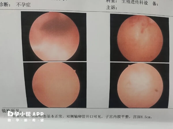 宫腔粘连可能会导致闭经