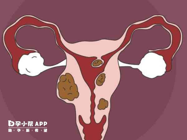 子宫肌瘤多发于30到50岁的妇女身上