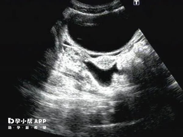 生理性盆腔积液会自行吸收