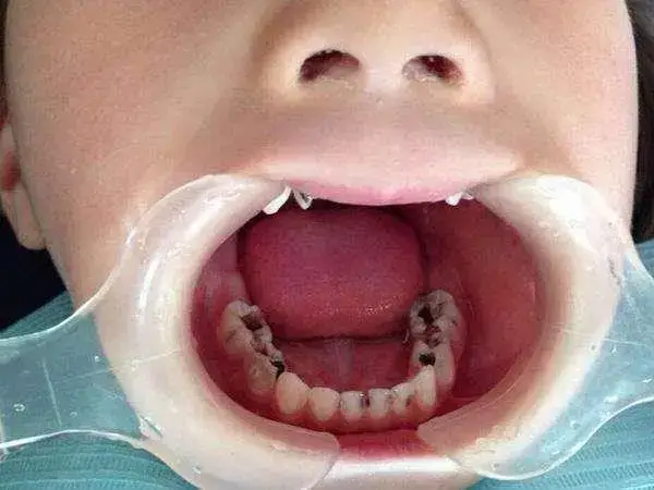 儿童患龋齿后应及时带去医院看口腔医生