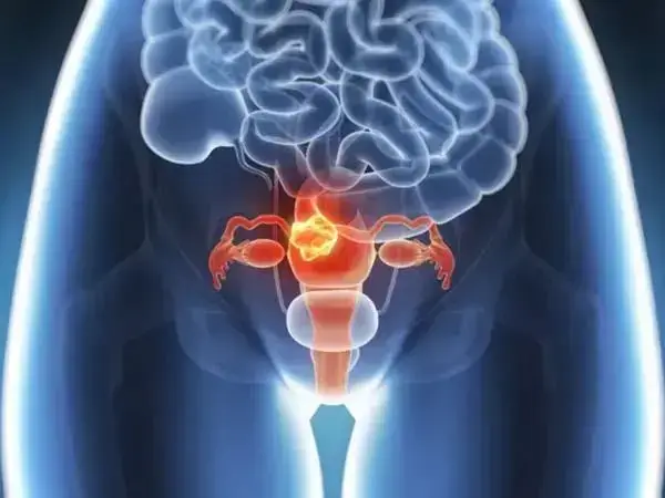 子宫内膜容受性不佳会导致女性不孕