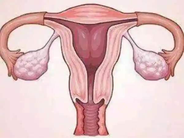 子宫畸形会导致受精卵无法着床