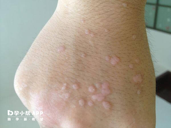 感染hpv病毒皮肤会有明显的表现