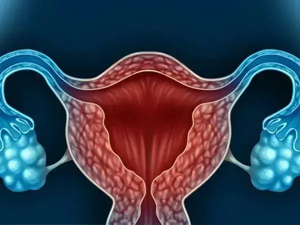 多囊卵巢患者是属于卵巢高反应人群
