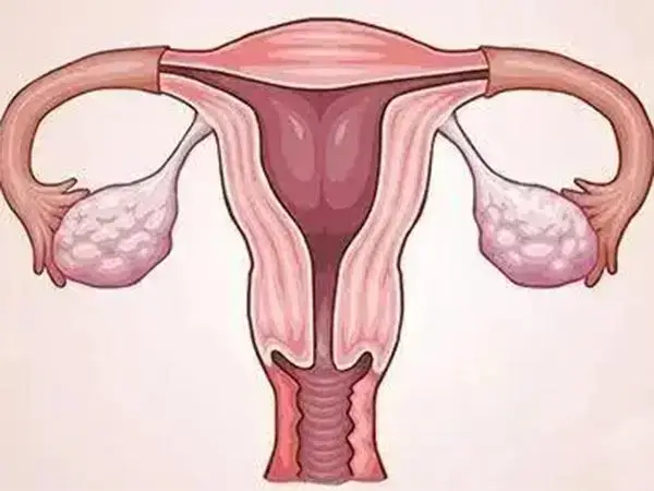多囊卵巢患者表现为月经异常
