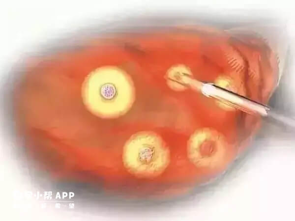 取卵后容易出现腹水