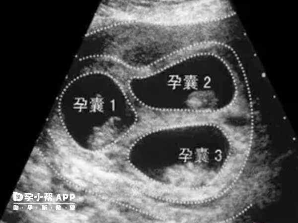 试管婴儿可以增加三胞胎概率