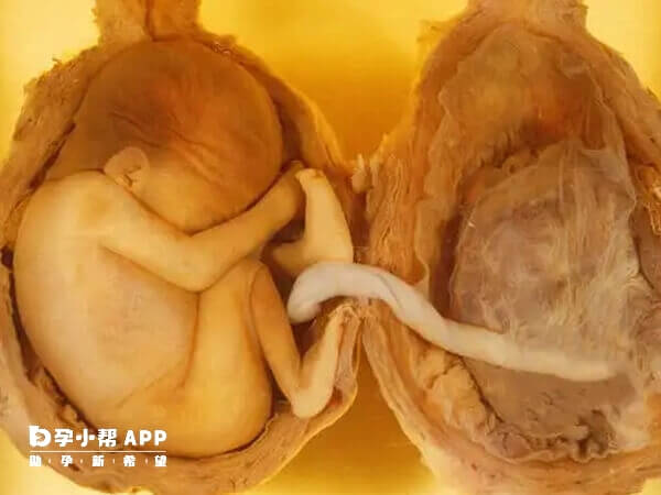 双胎之一有异常需要尽早做减胎手术