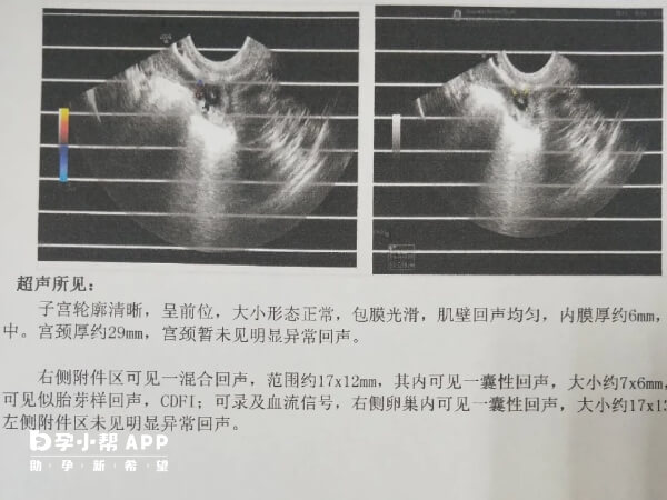 宫外孕是一种严重的妊娠风险