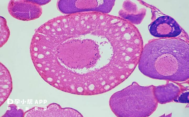 空卵泡综合征与促排药物可能有关