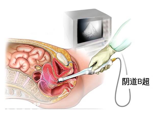 阴道B超检查