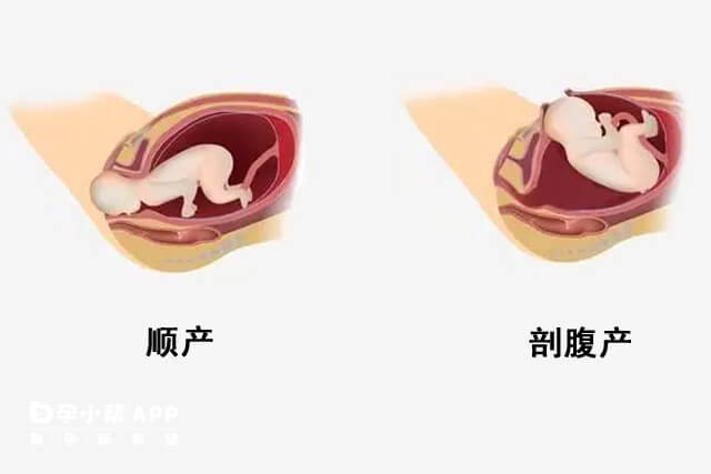 顺产与剖腹产示意图