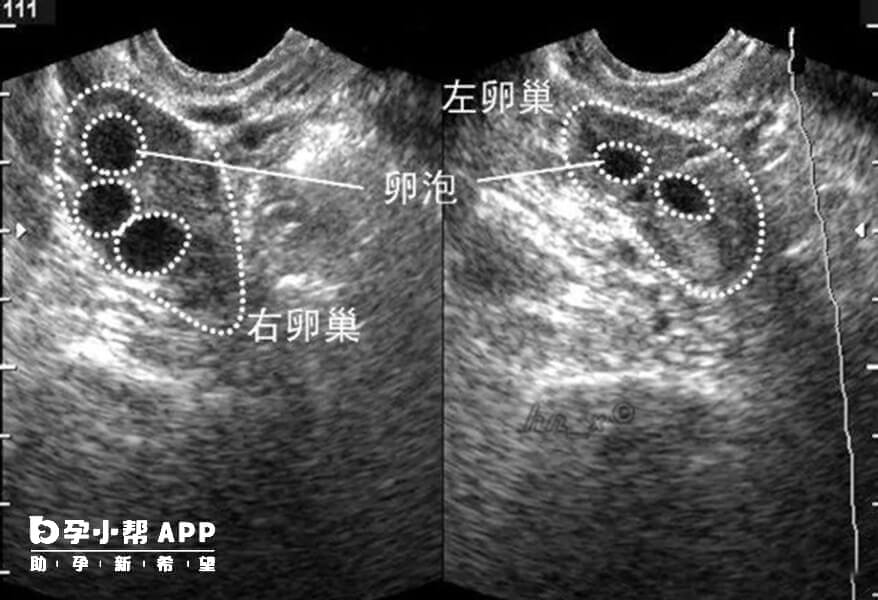 可以通过B超来观察卵泡的生长发育