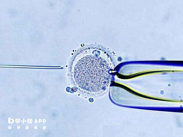 二代试管又叫单精子显微注射技术