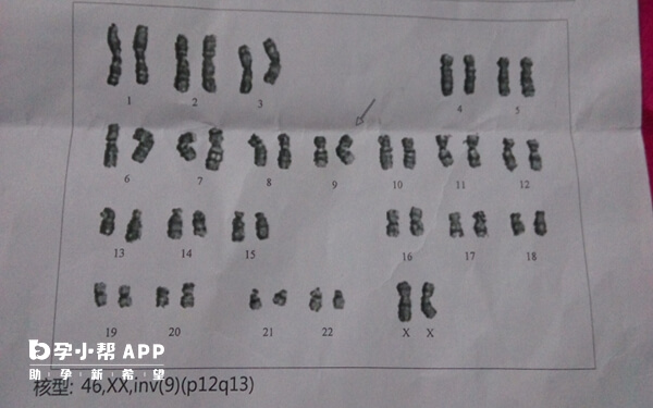 染色体倒位可能会影响生育