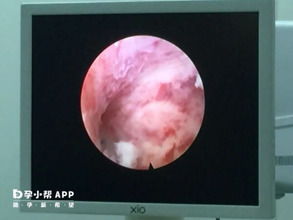 宫腔镜就是子宫的放大镜