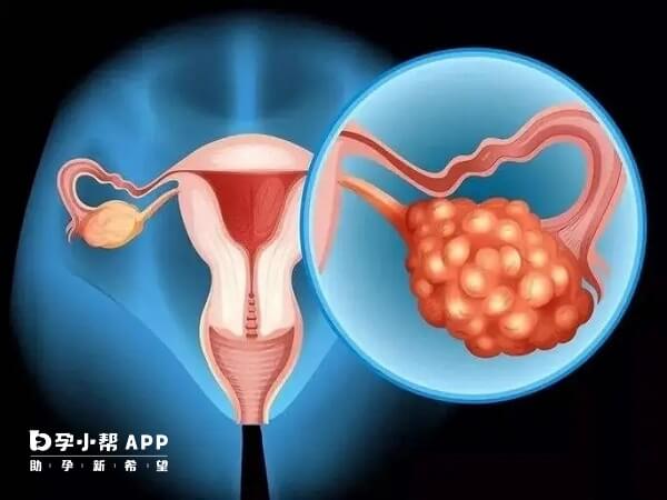 多囊卵巢取卵后容易出现腹水