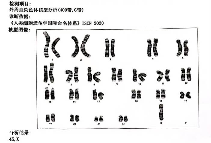 特纳综合征染色体核型