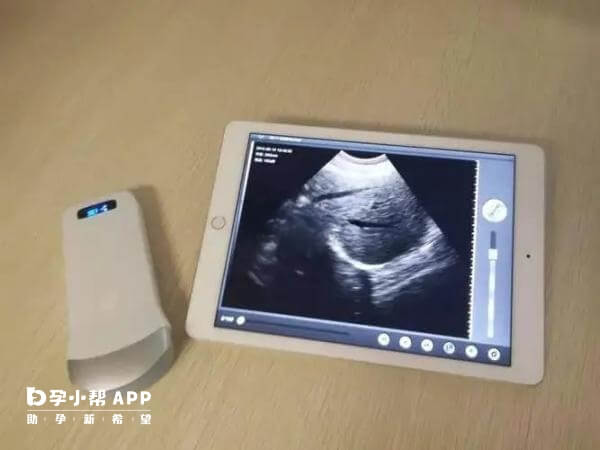 早孕期出血要排除宫外孕