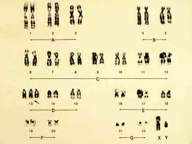 胎儿染色体13三体跟父母遗传的关系大吗？