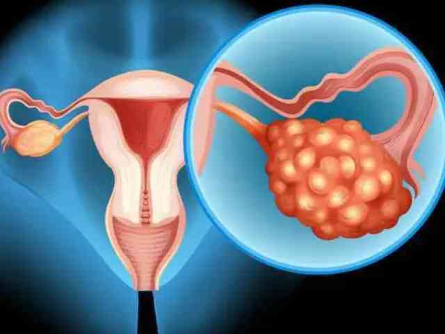 多囊卵巢怎么自己调理好得快？