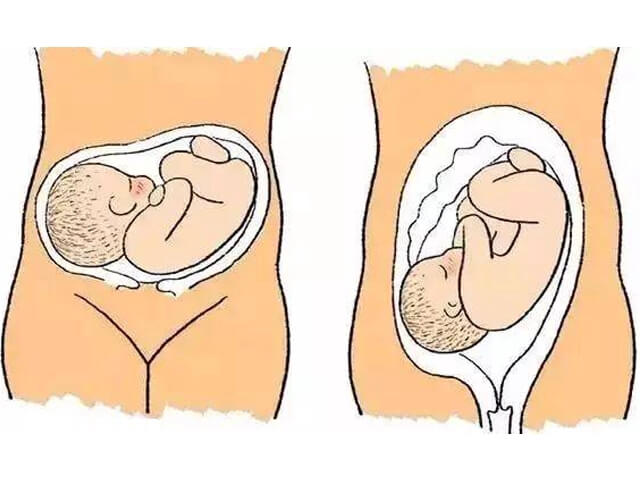 胎儿转动