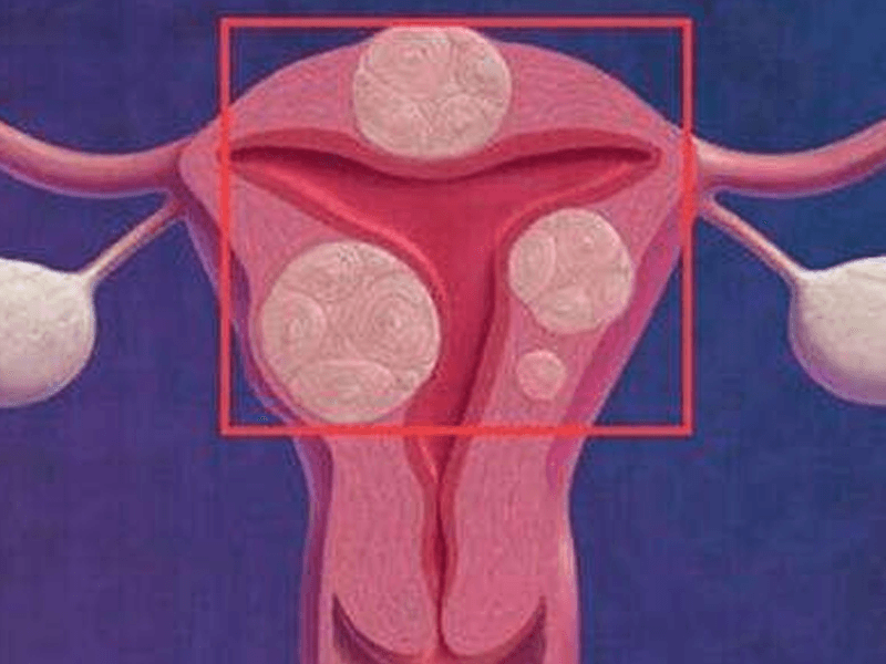 子宫肌瘤怀孕