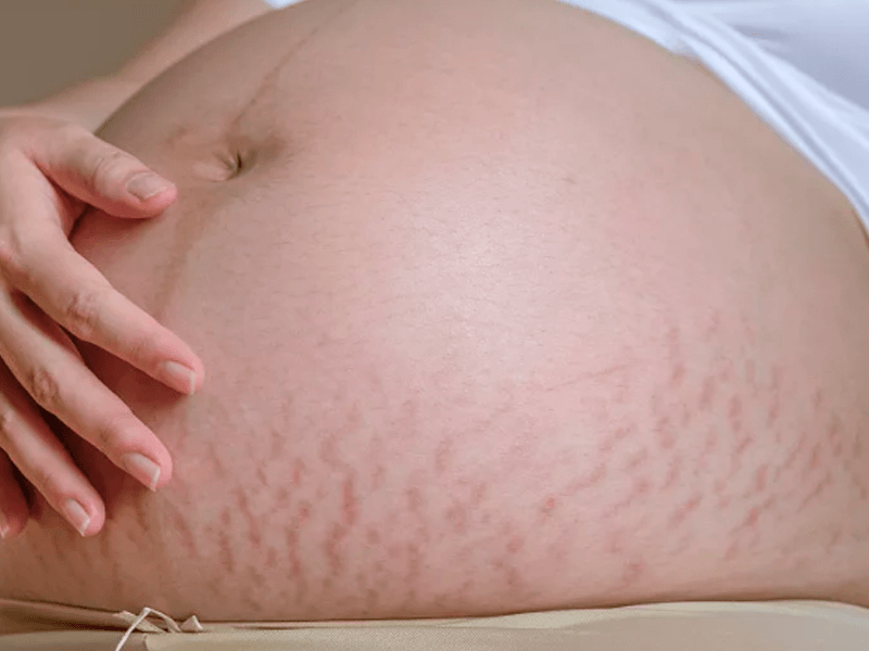 妊娠纹修复消除方法