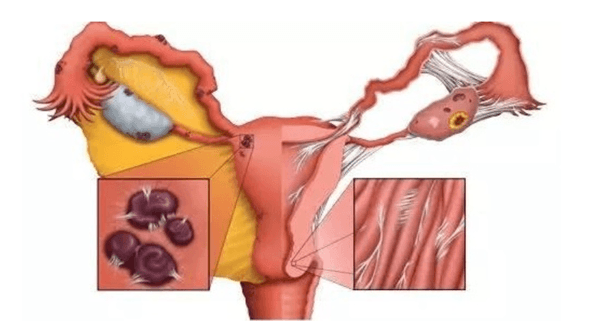 宫腔粘连是常见的妇科疾病