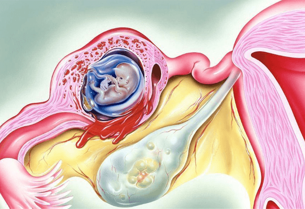 胚胎不在子宫内就是宫外孕