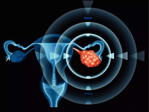 卵巢囊肿蒂扭转是宫外孕的征兆